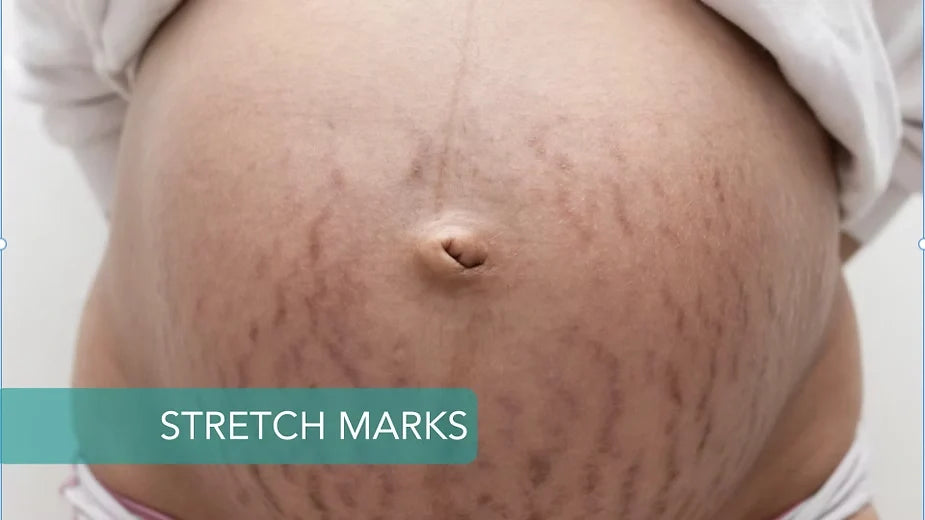 Stretch Marks During Pregnancy: Why They Happen and What You Can Do